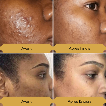 Duo Peau Nette – 1 Masque Acheté = Sérum à -50%