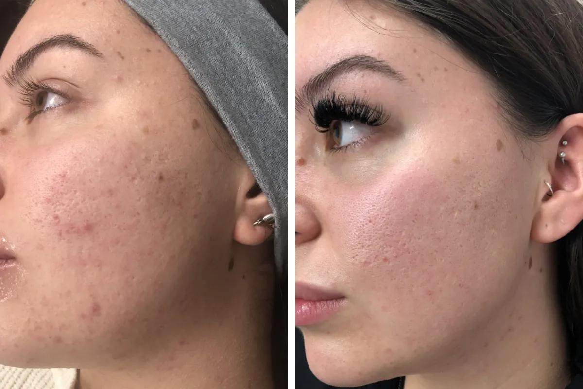 Yasmine B. – Peau réactive